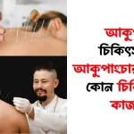 আকুপাংচার চিকিৎসা কি? আকুপাংচার কোন কোন চিকিৎসায় কাজ করে? আকুপাংচার চিকিৎসা কি? আকুপাংচার কোন কোন চিকিৎসায় কাজ করে?