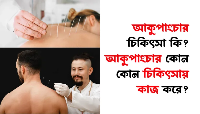 আকুপাংচার চিকিৎসা কি? আকুপাংচার কোন কোন চিকিৎসায় কাজ করে?